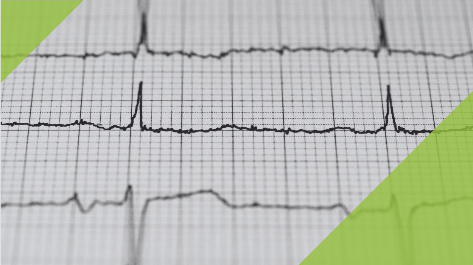 Bild von einem EKG Ausdruck